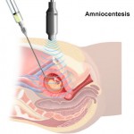 ¿La amniocentesis es obligatoria?