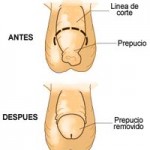 ¿Tendrán que hacerle la circuncisión a mi bebé?