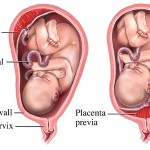 ¿Qué significa tener la placenta previa?